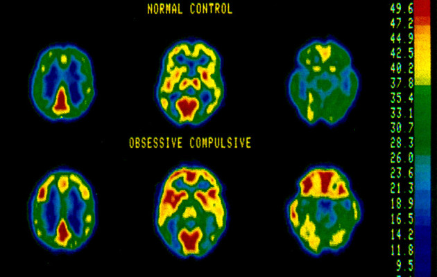 PET scan of increased OCD brain activity. Baxter et al (1987) ARCH GEN PSYCH 44
