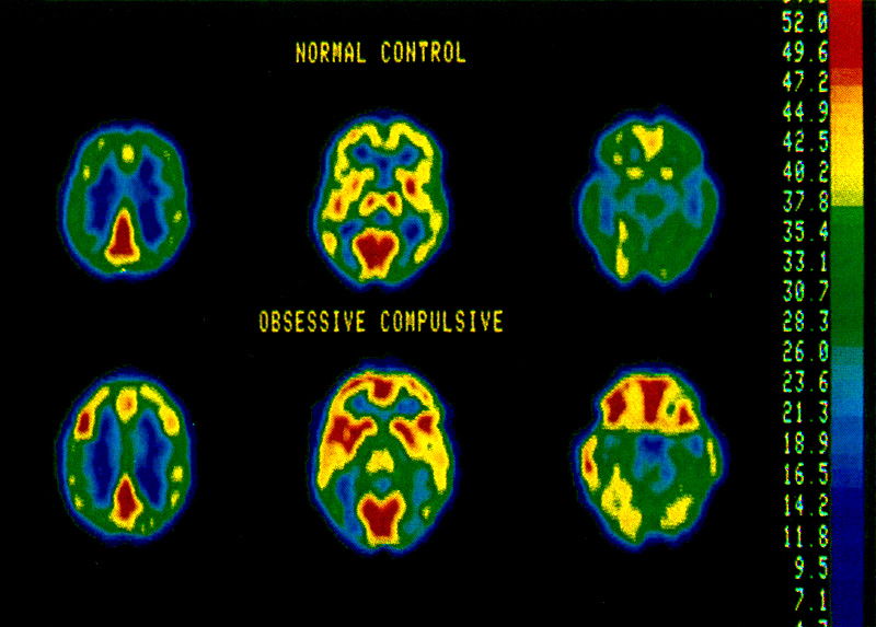 PET scan of increased OCD brain activity. Baxter et al (1987) ARCH GEN PSYCH 44